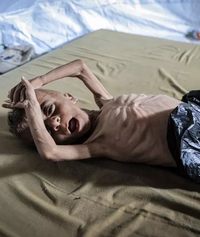 Starving Child in Gaza Starving Child in Gaza